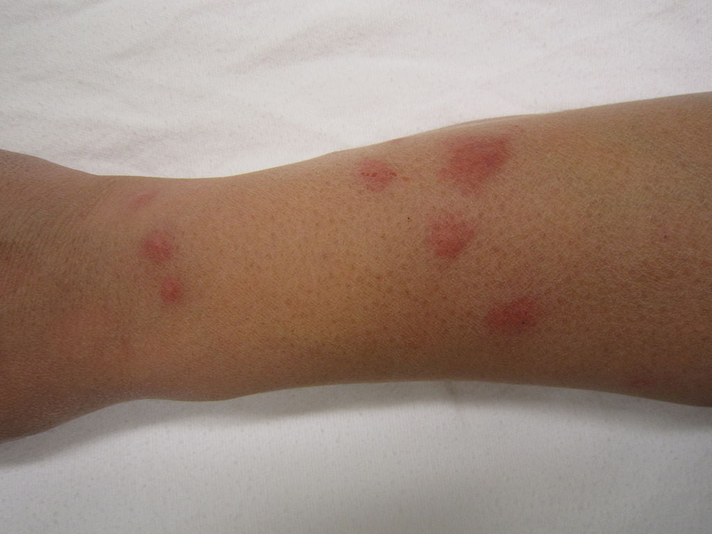 Signs Of Bed Bug Infestation Brisbane
